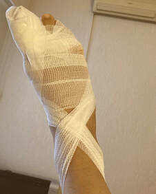 Bunionectomy Osteotomy Bandaged Foot Recovery at 4 weeksPicture