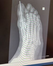 Kirshner Wire Bunion Picture